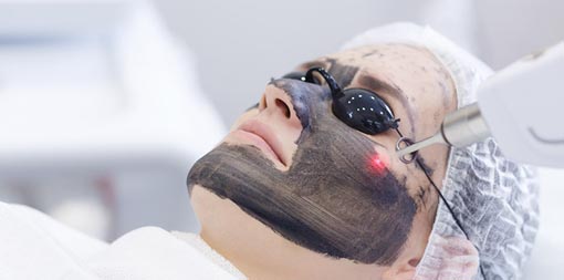 Laser carbon facial service