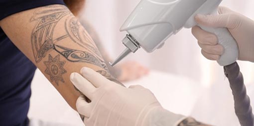 Laser tattoo removal service