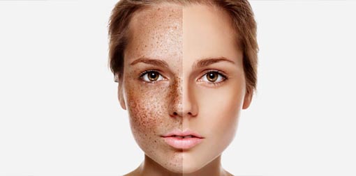 Pigmentation treatment service